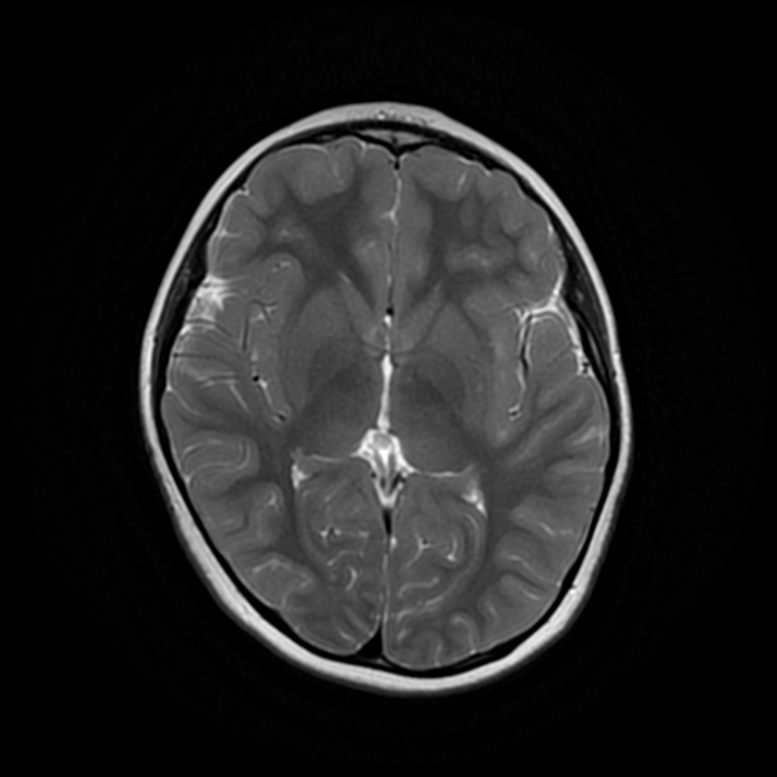 Adamantinomatous Craniopharyngioma Image Radiopaedia Org