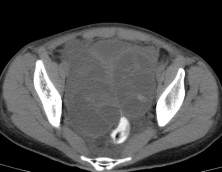 Ovarian Hyperstimulation Syndrome Image Radiopaedia Org