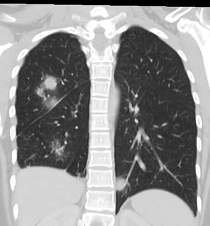 Granulomatosis With Polyangiitis Pulmonary Manifestations Radiology