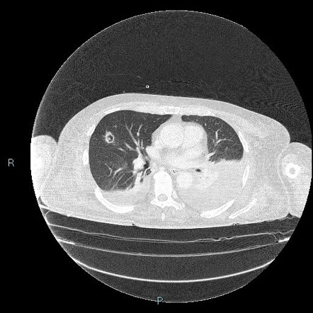 Invasive Pulmonary Aspergillosis Radiology Reference Article Radiopaedia Org