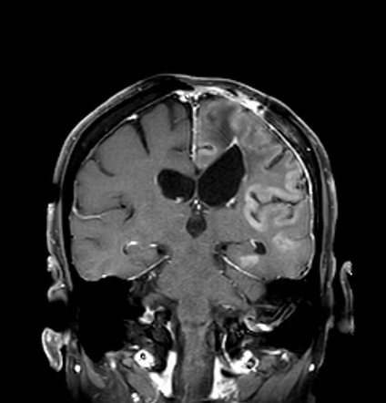 Gyral Enhancement Radiology Reference Article Radiopaedia Org