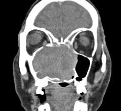 Rhinoscleroma Image Radiopaedia Org