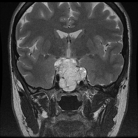 Chordoma Radiology Reference Article Radiopaedia Org