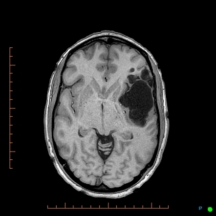 Intracranial Epidermoid Cyst Image Radiopaedia Org