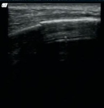 Rib Fracture Ultrasound Image Radiopaedia Org