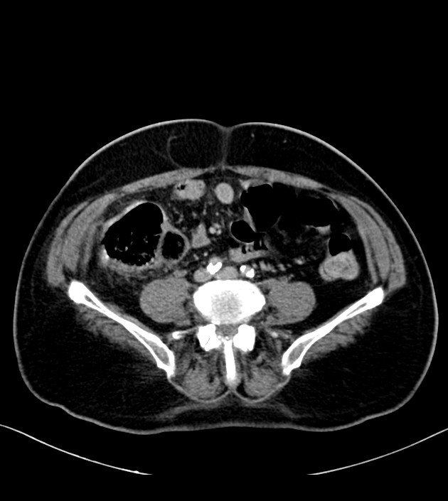 Ischemic Colitis Image Radiopaedia Org