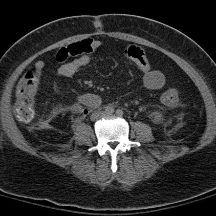 Emphysematous Pyelonephritis Bilateral Image Radiopaedia Org