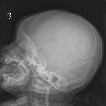 Metopic Suture Synostosis Image Radiopaedia Org