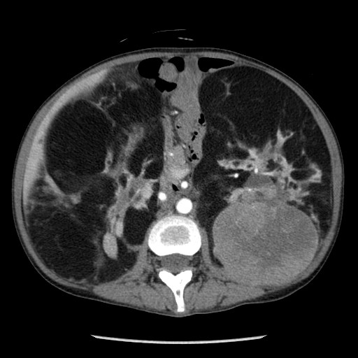 Renal Epithelioid Angiomyolipoma Image Radiopaedia Org