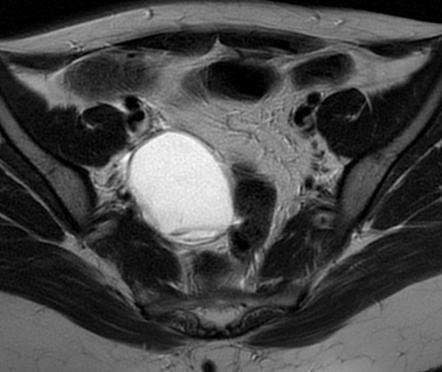 Hemorrhagic Ovarian Cyst Radiology Case Radiopaedia Org