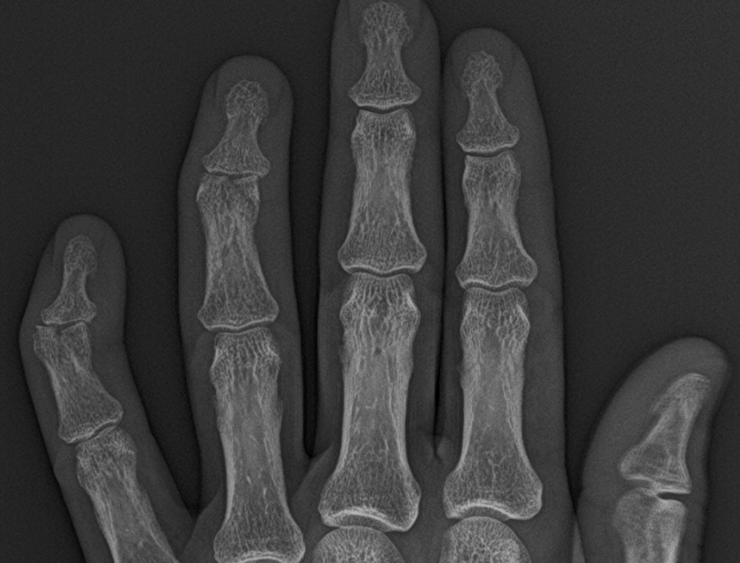 Middle Phalanx Fracture Image Radiopaedia Org