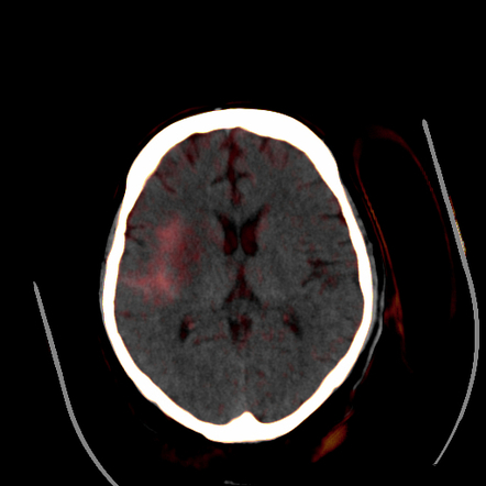 Subarachnoid Hemorrhage Radiology Reference Article Radiopaedia Org