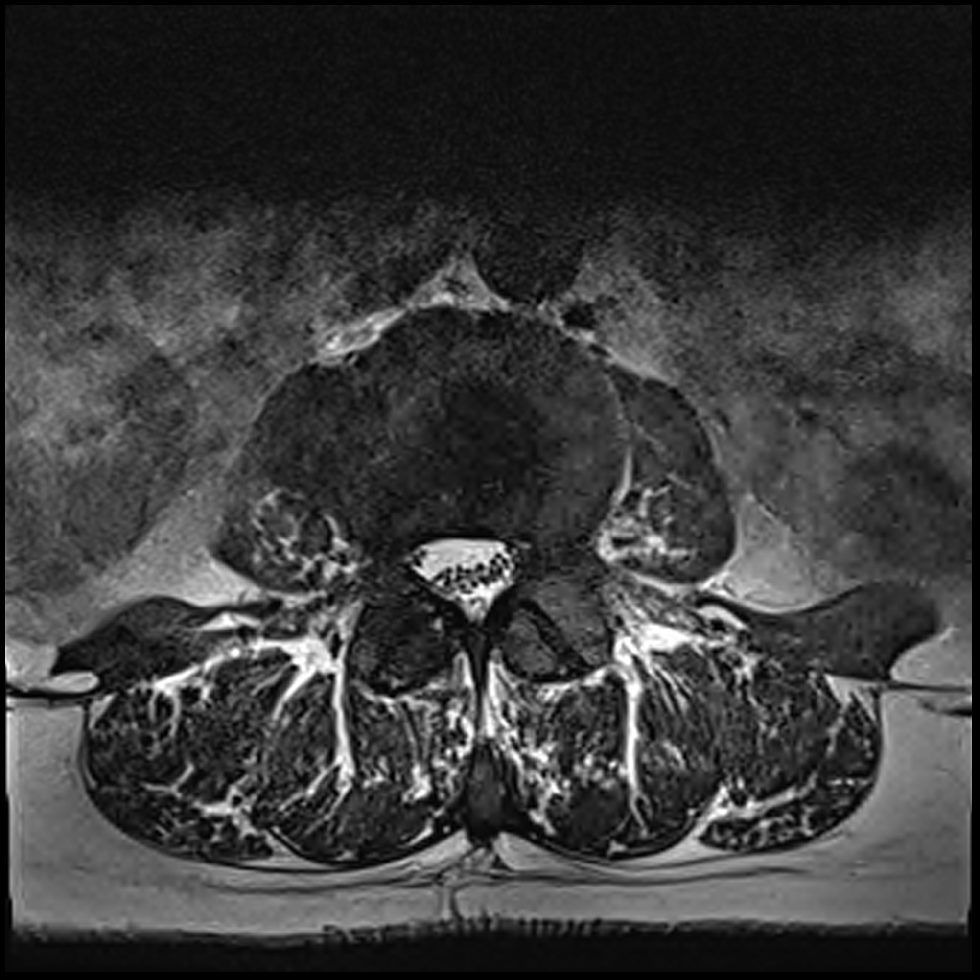 Spinal Cord Compression From Metastatic Prostate Cancer Image