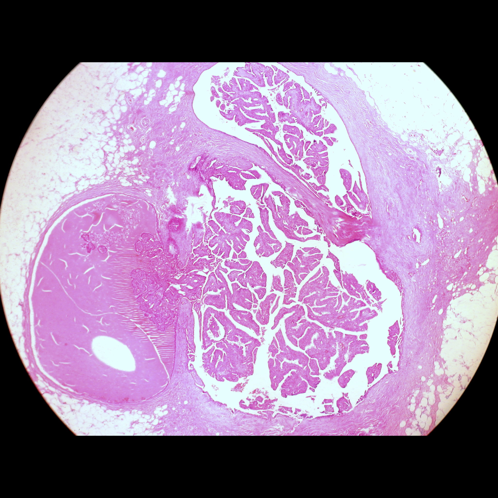 Intraductal Papilloma Of The Breast Image Radiopaedia Org