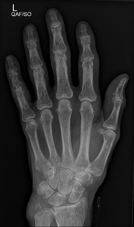 Ulnar Styloid Pathological Fracture From Gout Radiology Case