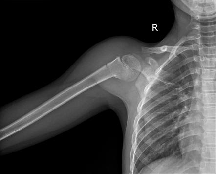 Greenstick Fracture Proximal Humerus Image Radiopaedia Org