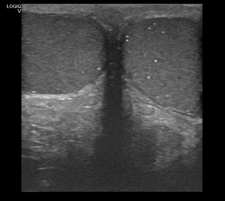 Testicular Microlithiasis Radiology Reference Article Radiopaedia Org