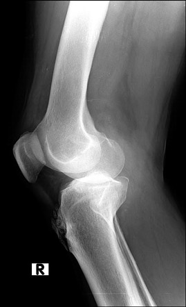 Osgood Schlatter Disease Chronic Radiology Case Radiopaedia Org