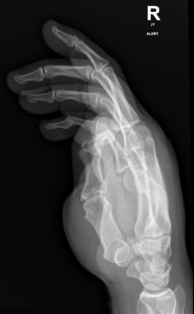 Acute 4th Metacarpal And Old 5th Metacarpal Fractures Image