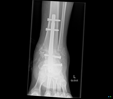 Tibiotalocalcaneal TTC Arthrodesis Image Radiopaedia Org