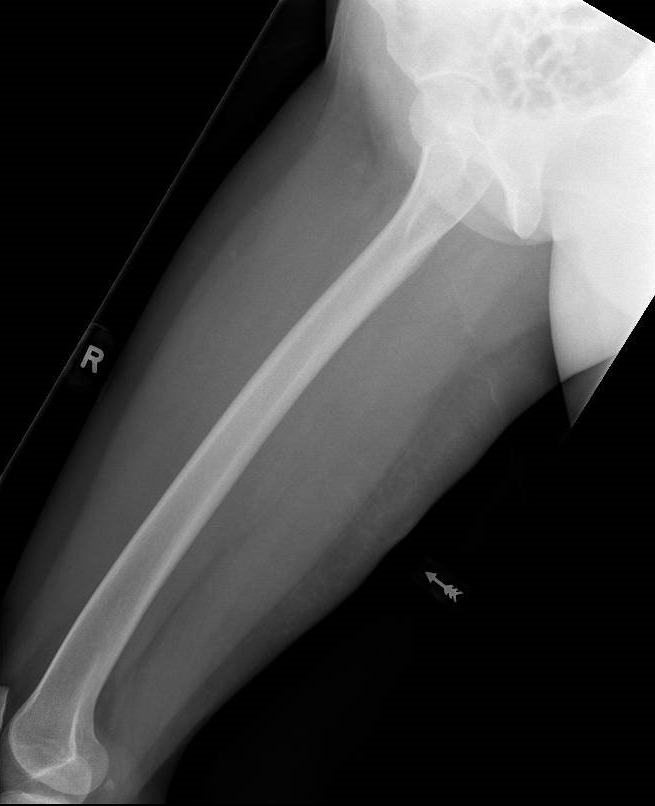 Normal Femur Series Image Radiopaedia Org