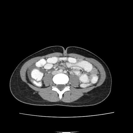 Perforated Appendicitis Radiology Case Radiopaedia Org