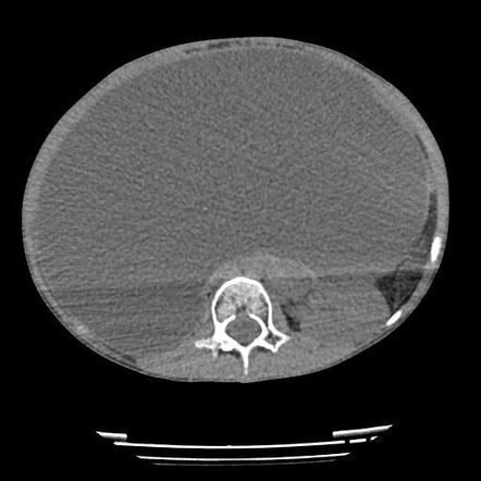 Mature Cystic Teratoma Radiology Case Radiopaedia Org