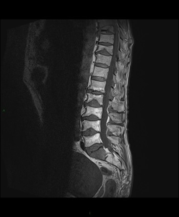 Metastatic Cord Compression Image Radiopaedia Org