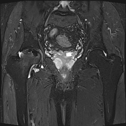 Avascular Necrosis Of Femur Radiology Case Radiopaedia Org