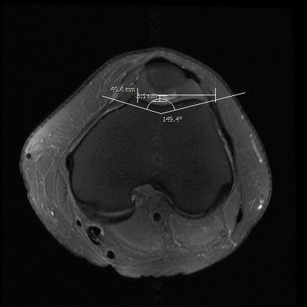 Excessive Lateral Pressure Syndrome Image Radiopaedia Org