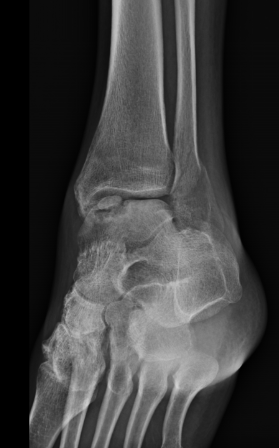 Osteochondral Lesion Talus Image Radiopaedia Org