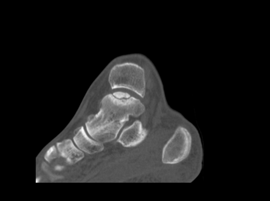 Osteochondral Lesion Talus Image Radiopaedia Org