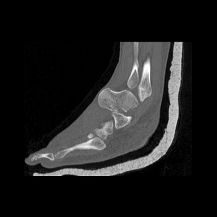 Total Talar Dislocation Radiology Reference Article Radiopaedia Org