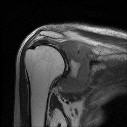 Central Atypical Cartilaginous Tumor Low Grade Chondrosarcoma