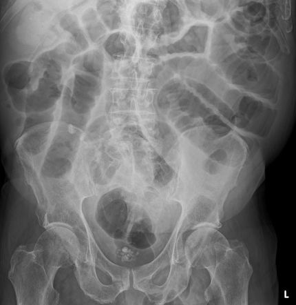 Small Bowel Obstruction Radiology Case Radiopaedia Org