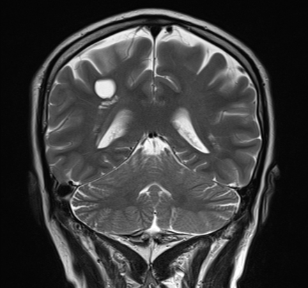 Arachnoid Cyst Cerebellopontine Angle Image Radiopaedia Org