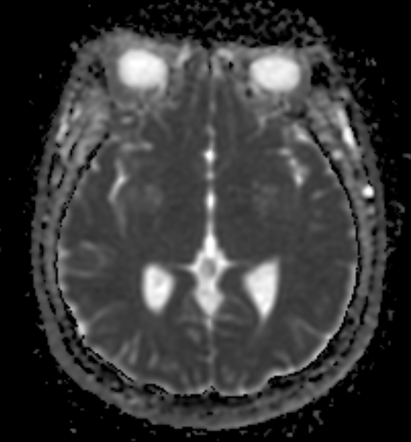 Closed Lip Schizencephaly With A Focal Cortical Dysplasia Image