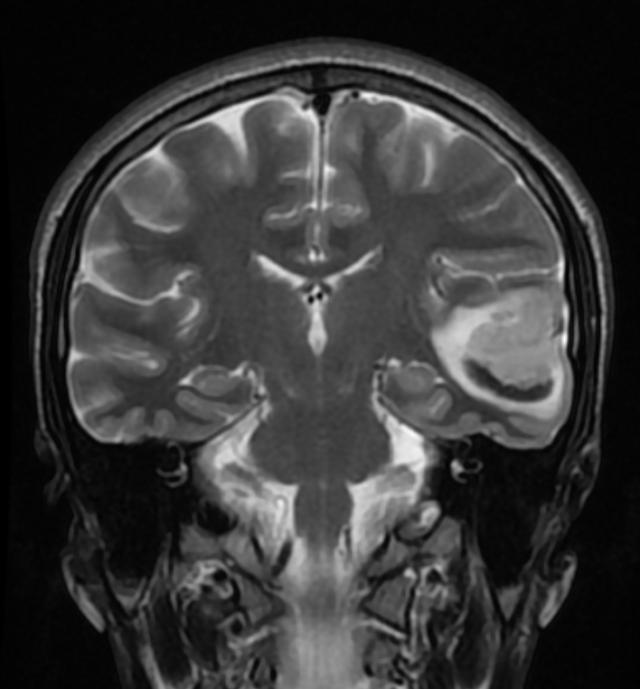 Cerebral Venous Thrombosis With Cerebral Venous Infarction Image