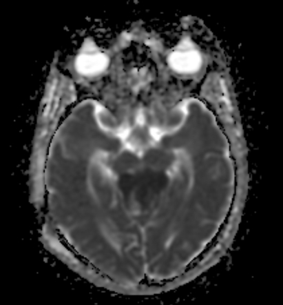 Meningioma Pineal Region Image Radiopaedia Org