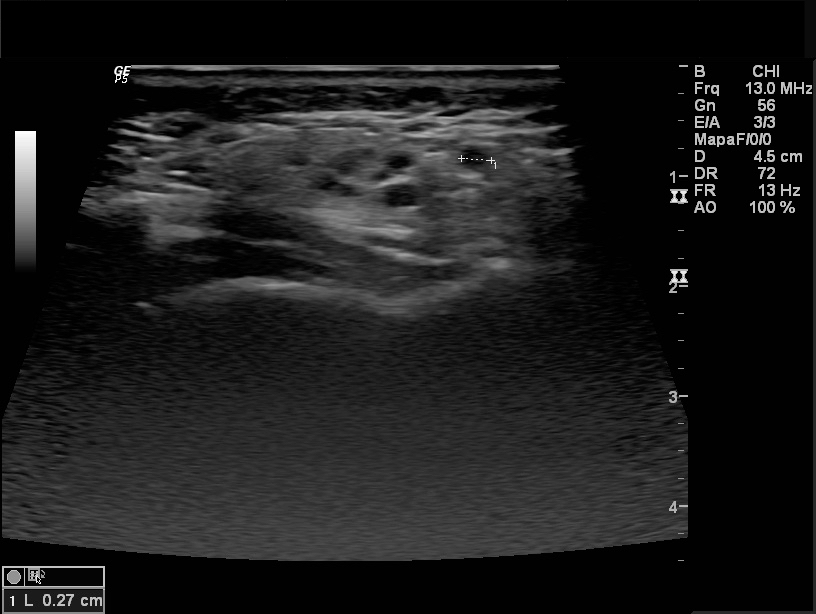 Infective Sialadenitis Mumps Image Radiopaedia Org