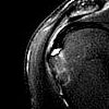 Rim Rent Tear Of The Supraspinatus Tendon Image Radiopaedia Org