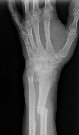 Galeazzi Fracture Dislocation Image Radiopaedia Org