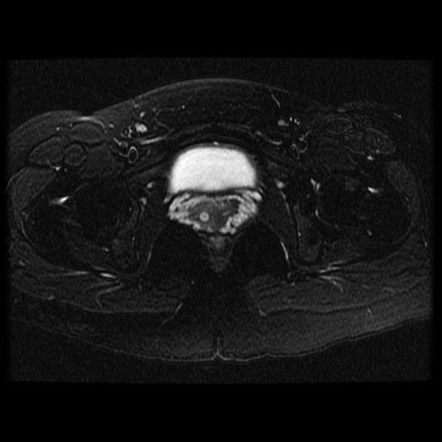 Uterus Didelphys Image Radiopaedia Org