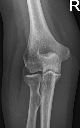 Subtle Radial Neck Fracture Image Radiopaedia Org