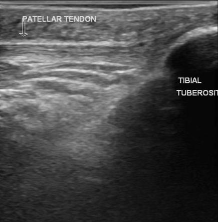 Post Traumatic Soft Tissue Cyst Knee Radiology Case Radiopaedia Org