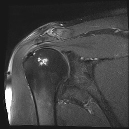 Bilateral Calcific Tendinitis Supraspinatus Tendon Image