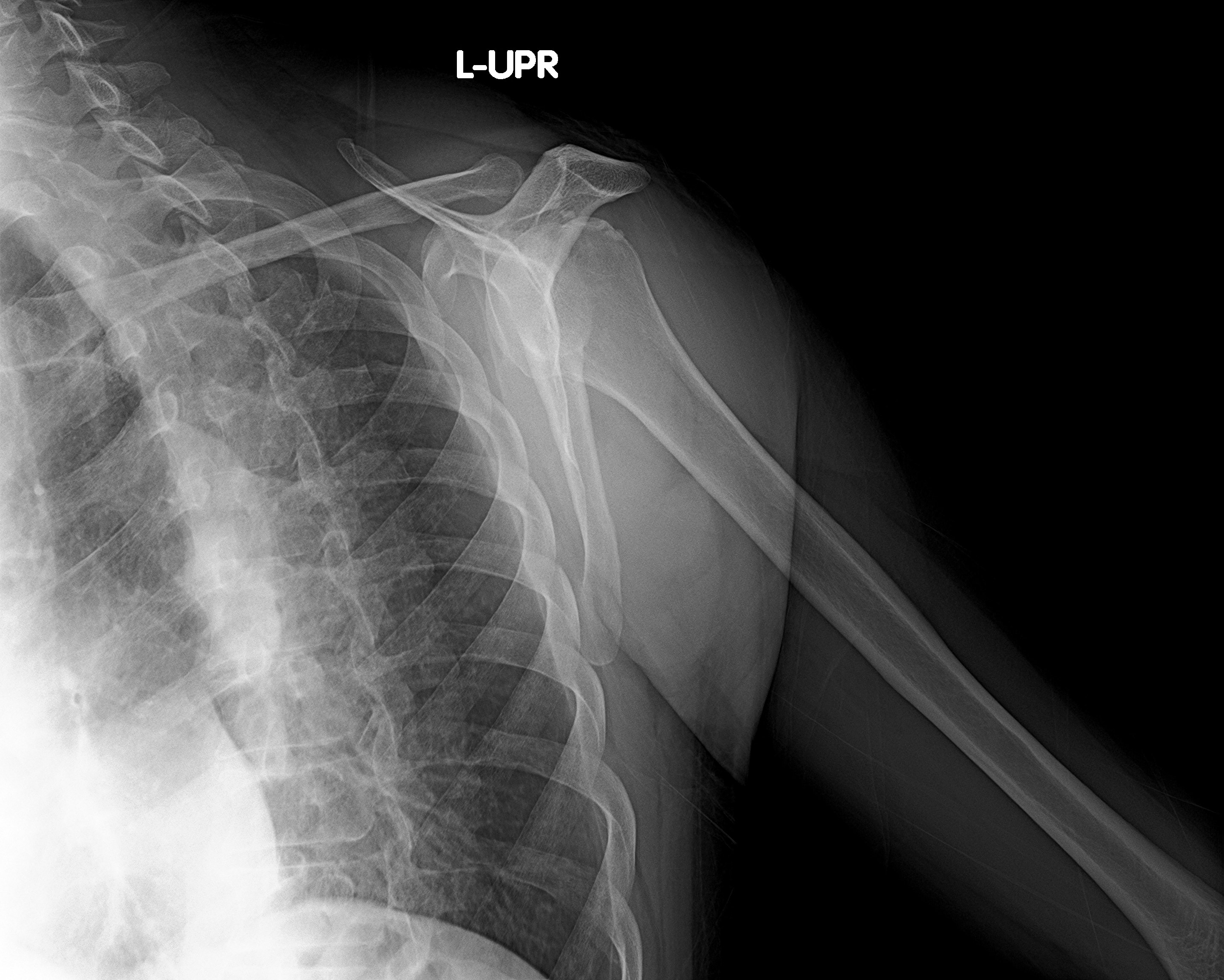 Calcific Tendinitis Supraspinatus Tendon Image Radiopaedia Org Hot Sex Picture