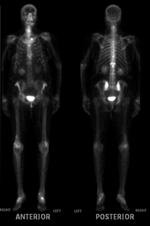 Mickey Mouse Sign In Paget Disease Radiology Case Radiopaedia Org