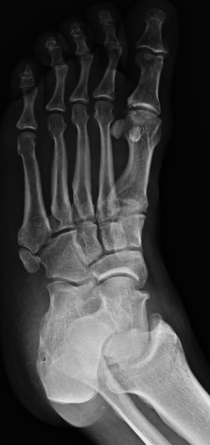 Os Trigonum And Unfused Apophysis Of The Proximal Th Metatarsal