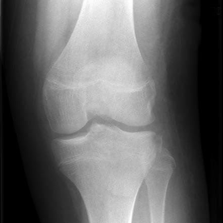 Posterior Cruciate Ligament Tear Radiology Reference Article The Best Porn Website